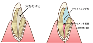 神経の無い歯をホワイトニング